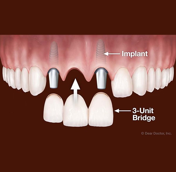 Dental Implants in Seguin, TX | Permanent Tooth Replacement